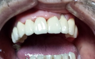 Metal-ceramic fixed bridge prosthesis - Clinical case 14, Photo 2