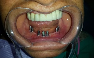 Implants and metal-ceramic fixed bridge - Clinical case 17, Photo 1