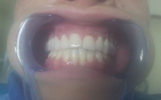 Metal-porcelain dental crowns - Clinical case 10, Photo 2