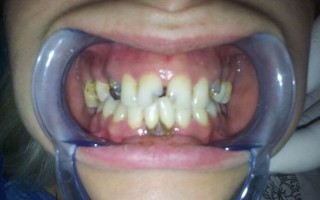 Metal-porcelain dental crowns - Clinical case 10, Photo 1