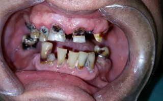 Fixed metal-ceramic bridges - Clinical case 31, Photo 1