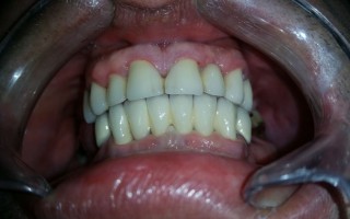 Fixed metal-ceramic bridges - Clinical case 31, Photo 2