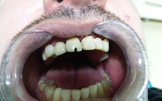 Fixed metal-ceramic dental crown - Clinical case 29, Photo 1