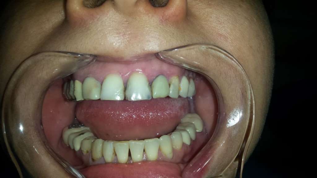 Chamfer polishing Dentist in Bucharest