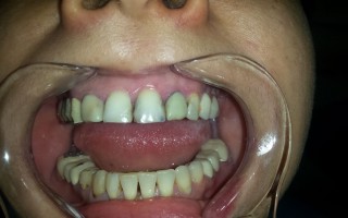 Protecting frontal teeth with ceramic work - Clinical case 27, Photo 1