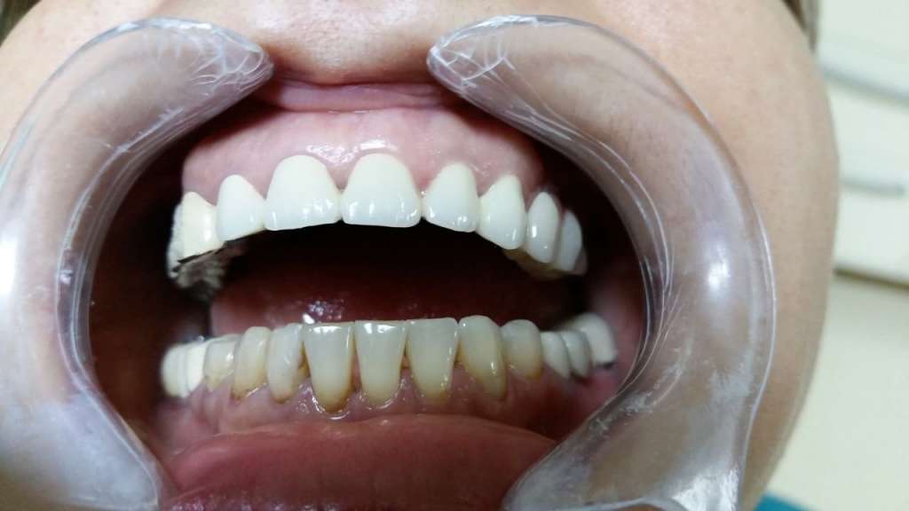 Chamfer polishing Dentist in Bucharest