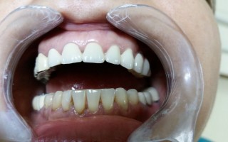 Protecting frontal teeth with ceramic work - Clinical case 27, Photo 2