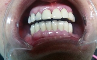 Fixed prosthesis with metal-ceramic work - Clinical case 30, Photo 2
