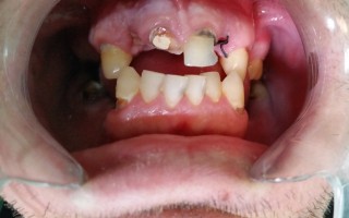 Malocclusions and metal-ceramic crowns - Clinical case 32, Photo 1