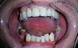 Malocclusions and metal-ceramic crowns - Clinical case 32, Photo 3