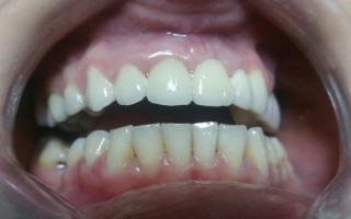 Fixed ceramic and metal-ceramic crowns - Clinical case 33, Photo 2