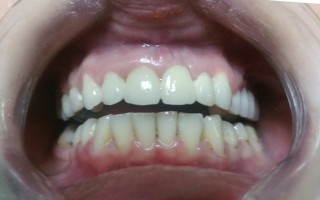 Fixed ceramic and metal-ceramic crowns - Clinical case 33, Photo 3