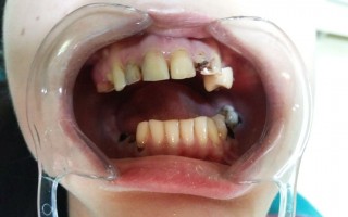 Metal-ceramic work (design) - Clinical case 34, Photo 1