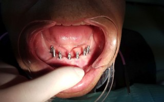 Fixed prosthetic work: 8 implants and prosthesis - Clinical case 35, Photo 1