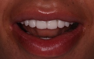 EMax dental crowns - Clinical case 37, Photo 1