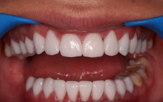 EMax dental crowns - Clinical case 37, Photo 2