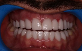 EMax dental crowns - Clinical case 39, Photo 1