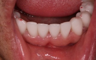 EMax dental crowns - Clinical case 39, Photo 2