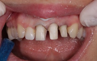 E-Max crowns and facets - Clinical case 40, Photo 1