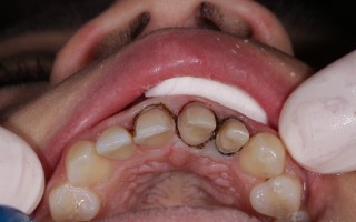 E-Max crowns and facets - Clinical case 40, Photo 2