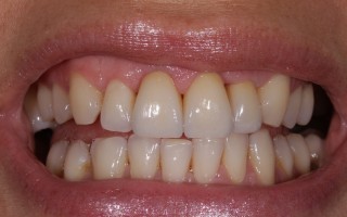 E-Max crowns and facets - Clinical case 40, Photo 3