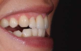 E-Max crowns and facets - Clinical case 40, Photo 4