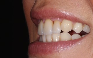 E-Max crowns and facets - Clinical case 40, Photo 5