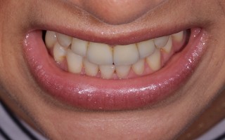 E-Max crowns and facets - Clinical case 40, Photo 6