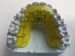 Metal-porcelain dental crowns