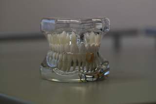 Dental implants